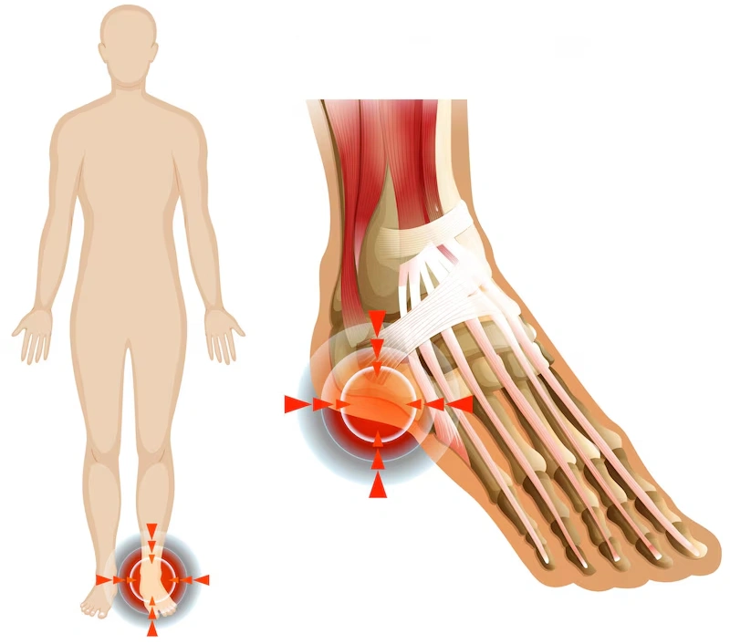 Cure your Plantar Fasciitis with the Right Guide
