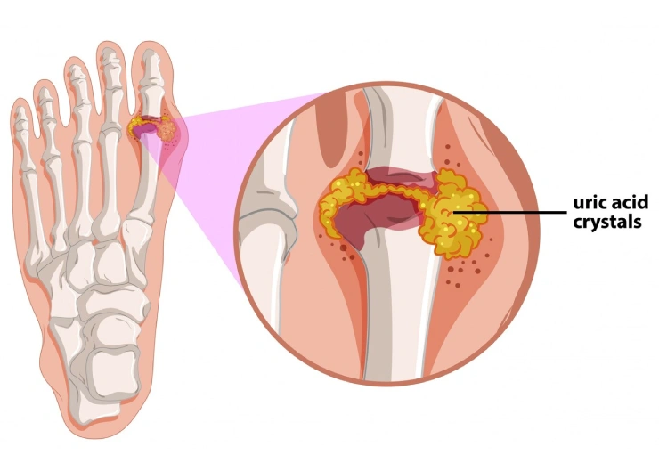 Gout Disease