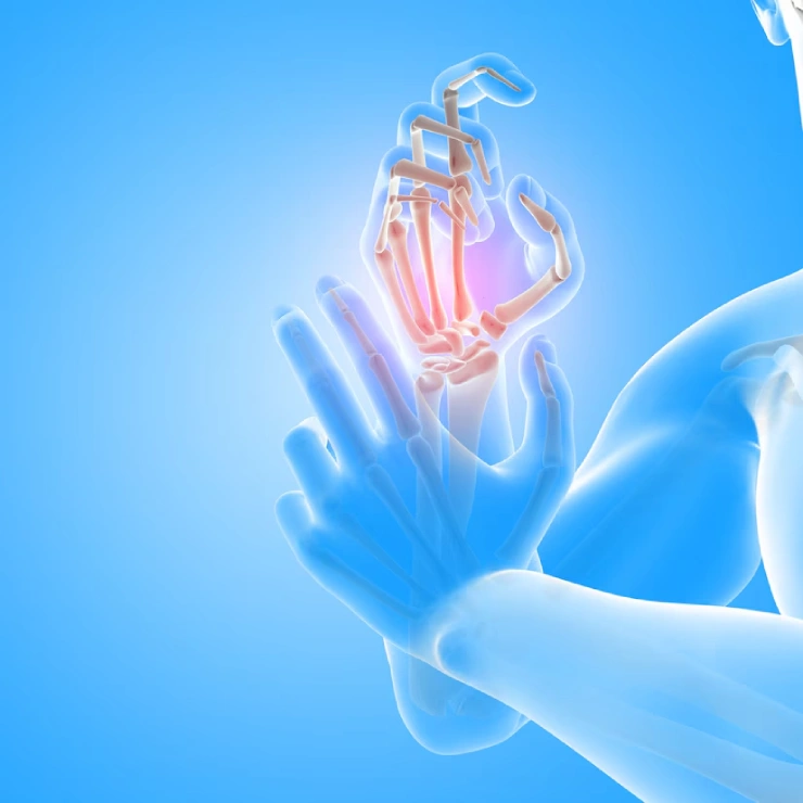 How Can You Manage a Gout Attack?
