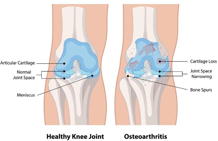 Osteoarthritis of the Knee | Learn Everything at One Place