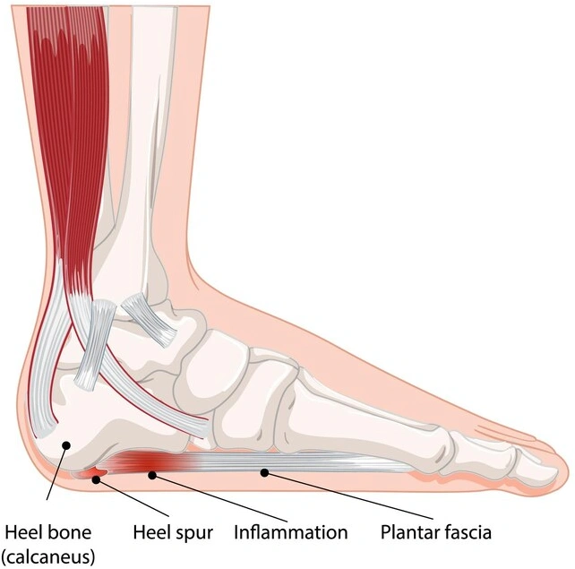 What Does Plantar Fasciitis Feel Like?